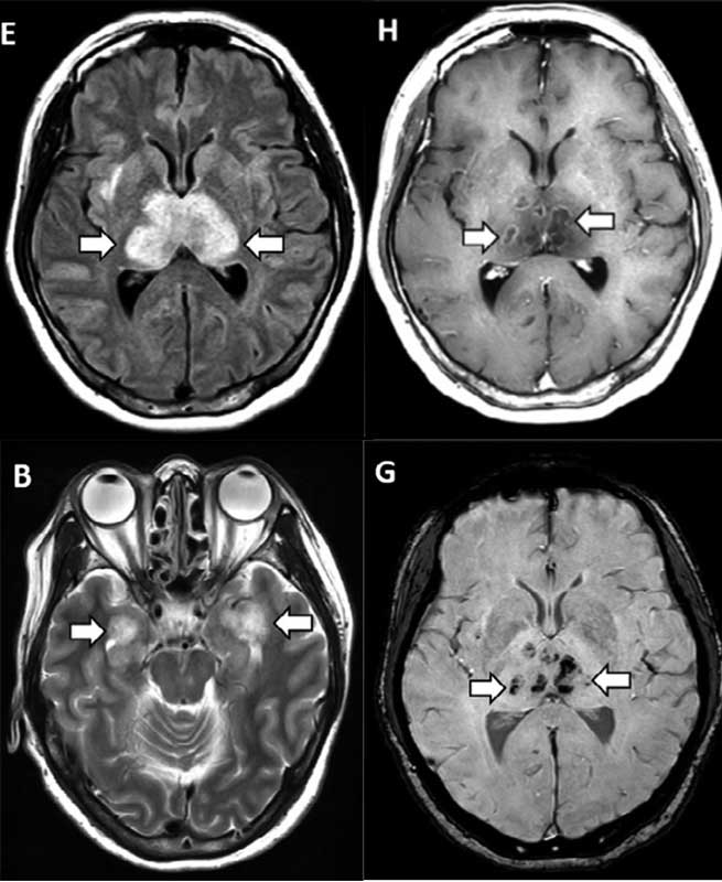 Рис. 1. Магнитно-резонансные томограммы головного мозга пациентки (в возрасте 50 лет) с COVID-19. T2-FLAIR (B, E), постконтрастное изображение (H), SWI (G) свидетельствуют о геморрагическом повреждении зрительных бугров, височных долей.