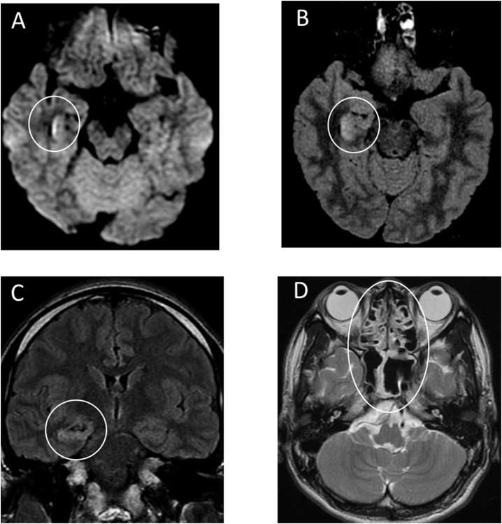 Рис. 2. МРТ головного мозга мужчины (в возрасте 24 лет) с COVID-19 с эпизодом спутанности и судорожным синдромом (анализ ликвора на COVID-19 положительный). А: DWI, гиперинтенсивность стенки нижнего рога правого бокового желудочка; B, C: FLAIR, гиперинтенсивный МР-сигнал в проекции правой медиальной височной доли и гиппокампа с сопутствующей субатрофией гиппокампа; D, Т2-ВИ, признаки пансинусита.